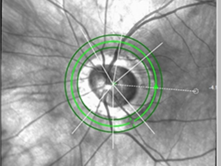 Forschung: Neues OCT-Verfahren zur Glaukom-Früherkennung
