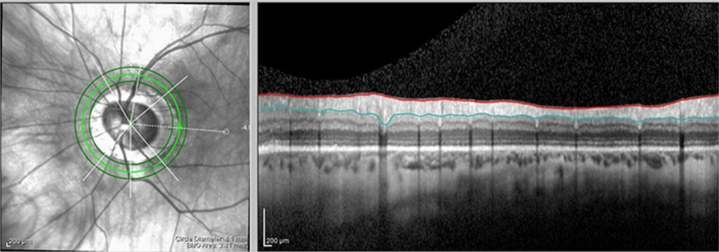 Ergebnisse einer OCT-basierten Untersuchung: Die Abbildung zeigt eine (gesunde) Netzhaut (links). Bei einem Glaukom würden die rote und die grüne Linie rechts im Bild deutlich weiter auseinanderliegen. 