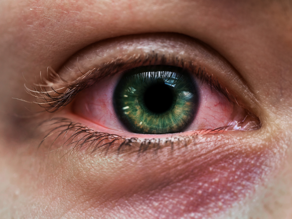 Nahaufnahme eines weiblichen Auges mit vielen roten Äderchen als Zeichen einer Augenerkrankung