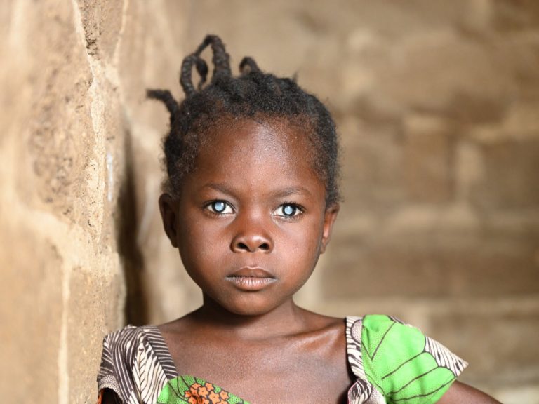 Mädchen aus Kamerun mit milchigen Augen hat Grauen Star