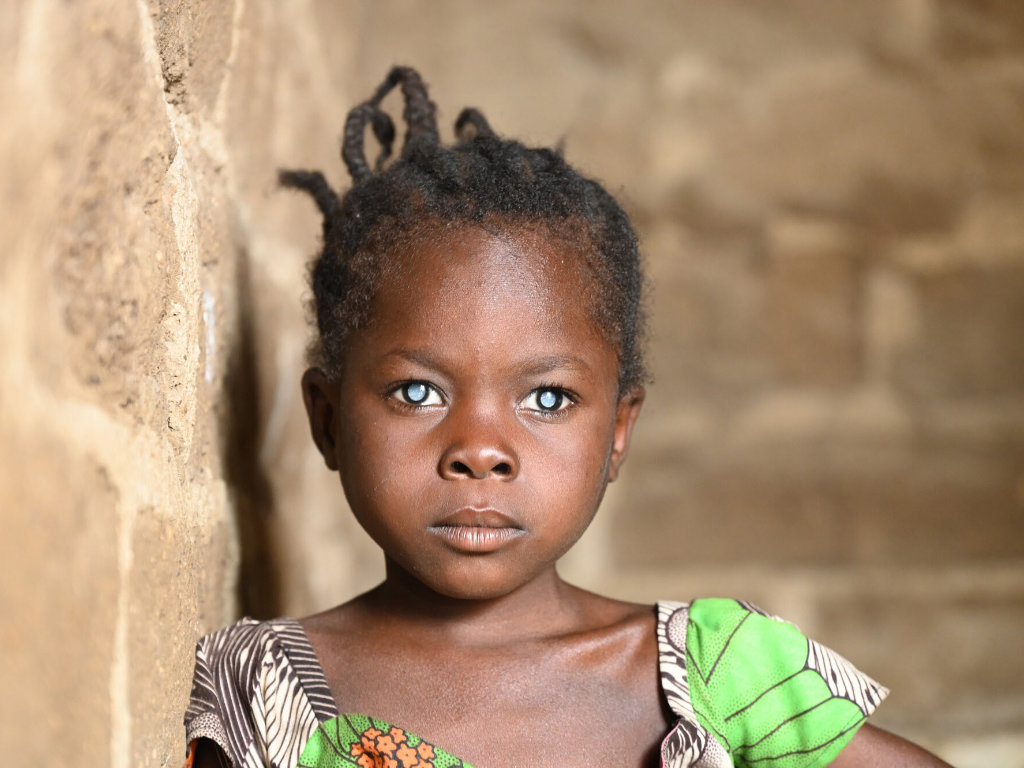 Mädchen aus Kamerun mit milchigen Augen hat Grauen Star